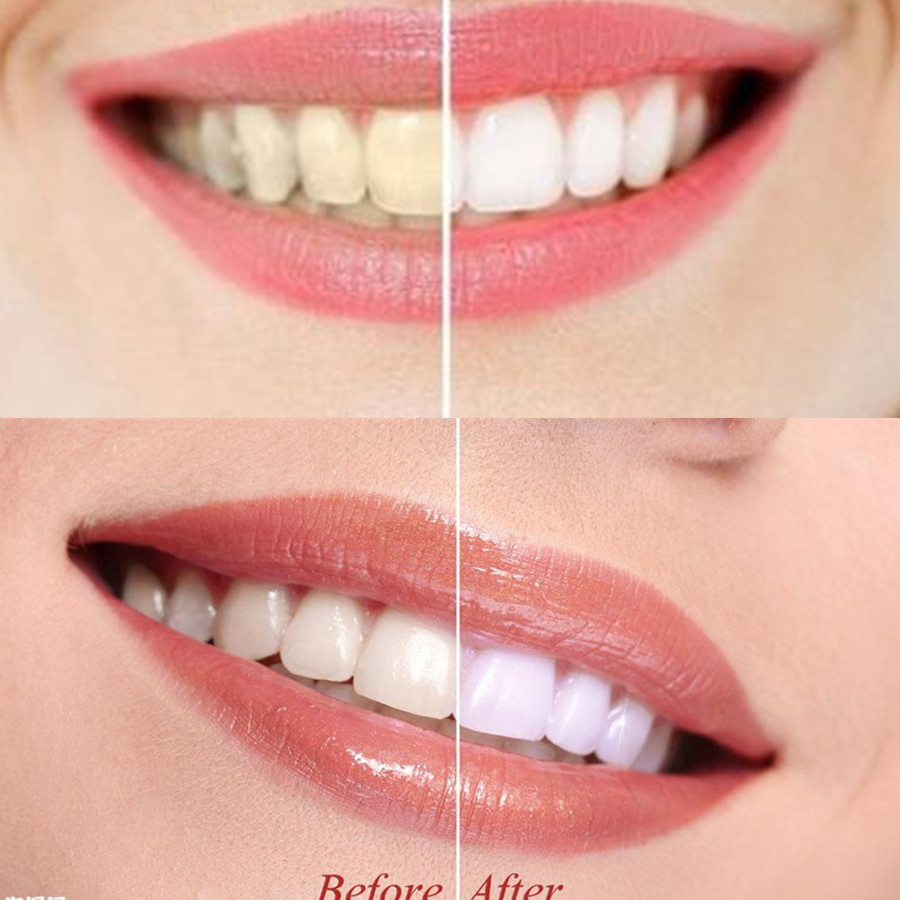 Dentes de carvão vegetal de ba - Teeth Whitening Near Me avaliação e preço