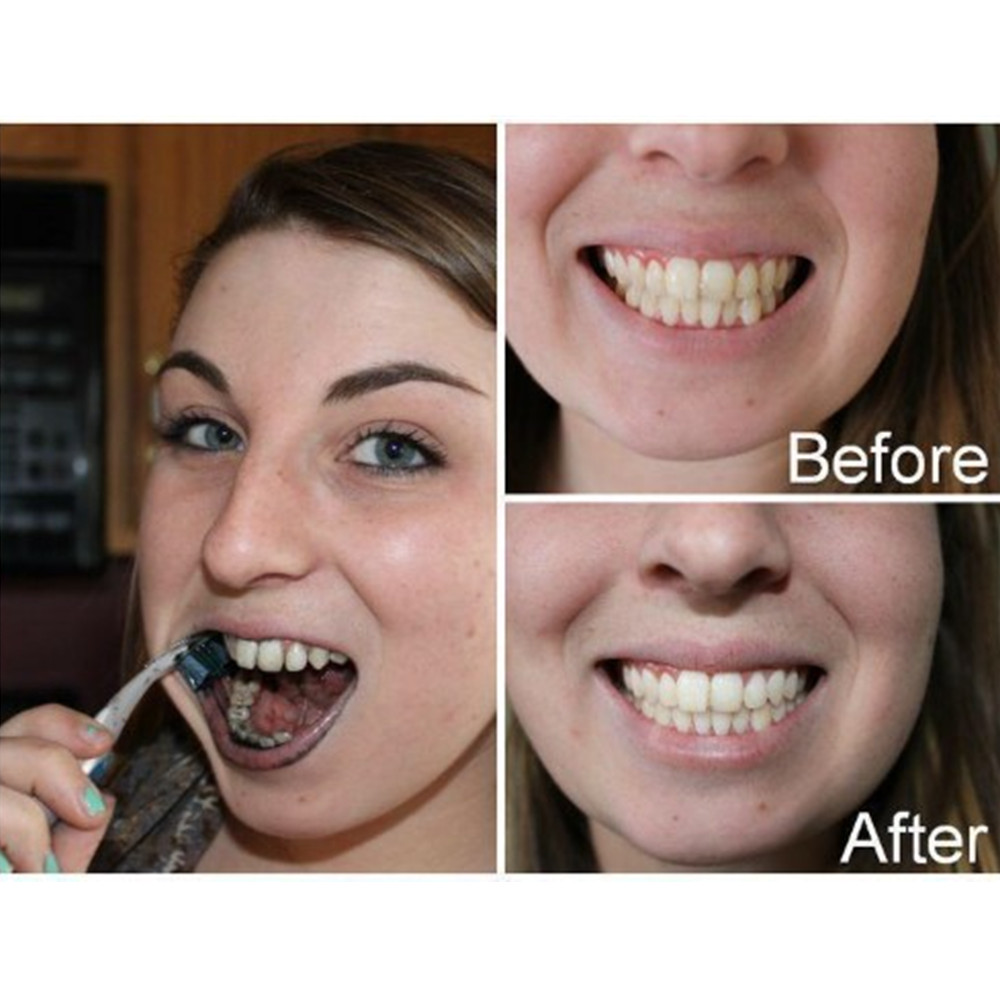 Dentes de carvão vegetal de ba - Teeth Whitening Near Me avaliação e preço