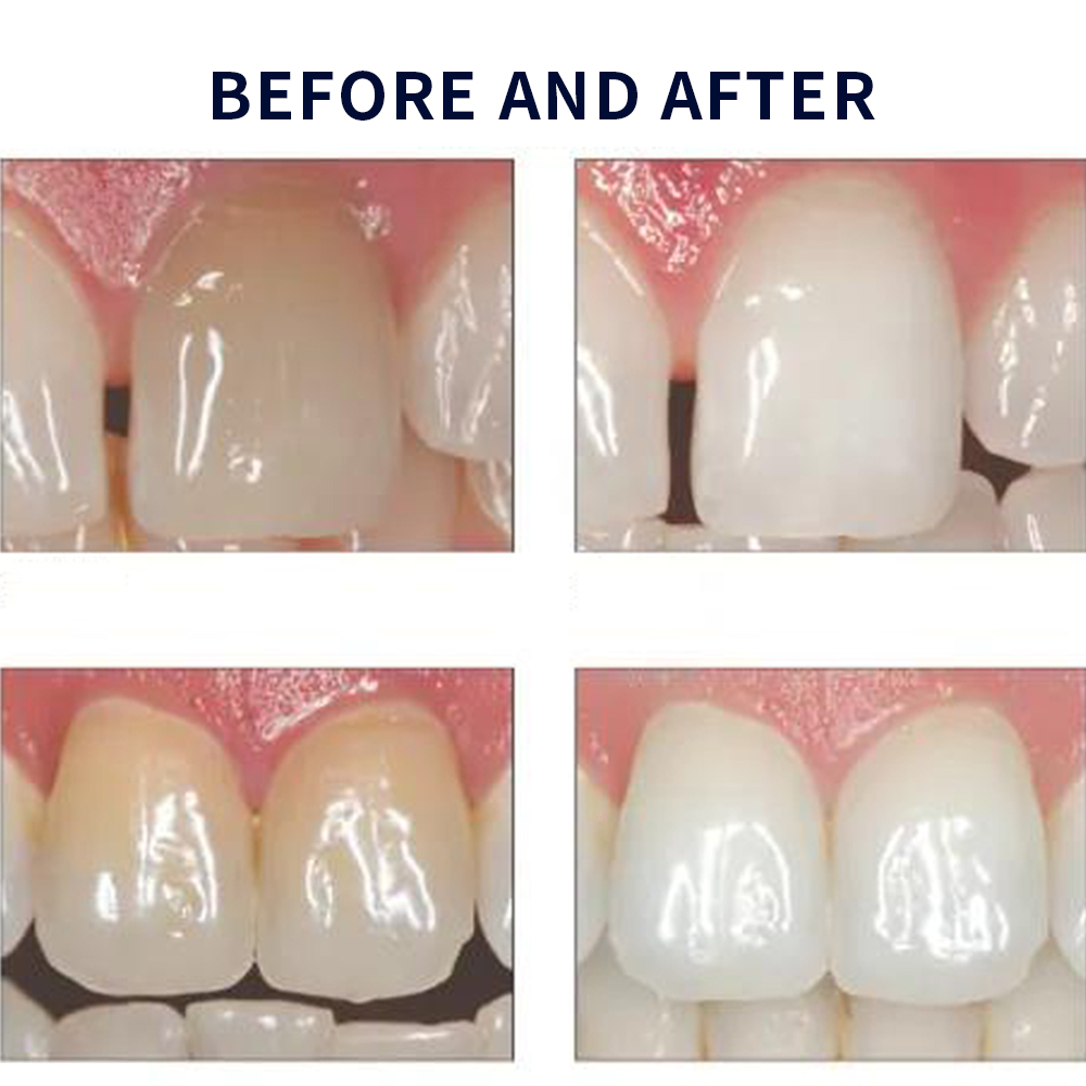 Opalescência Whitening Gel Kit - Teeth Whitening Near Me avaliação e preço