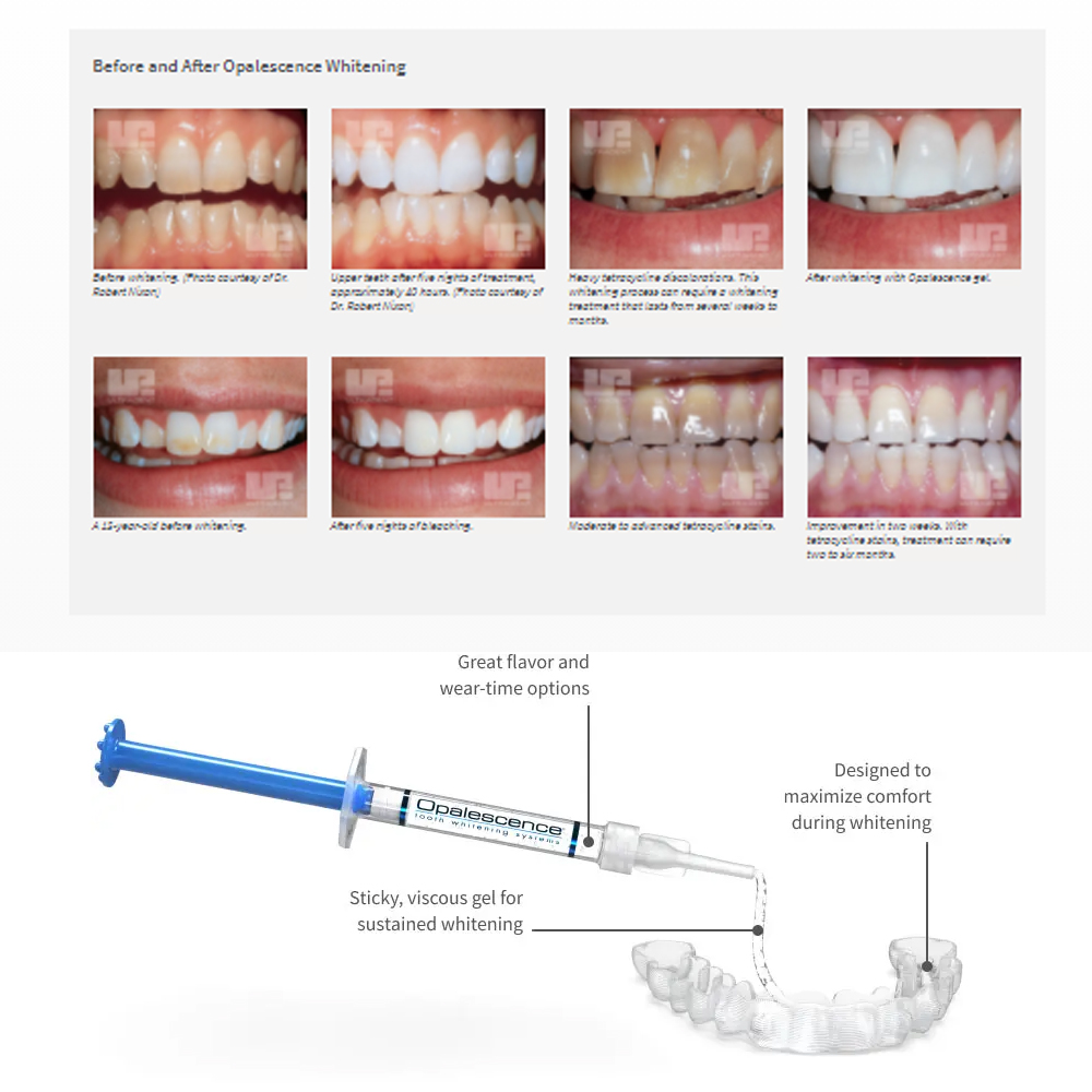 Opalescência Whitening Gel Kit - Teeth Whitening Near Me avaliação e preço