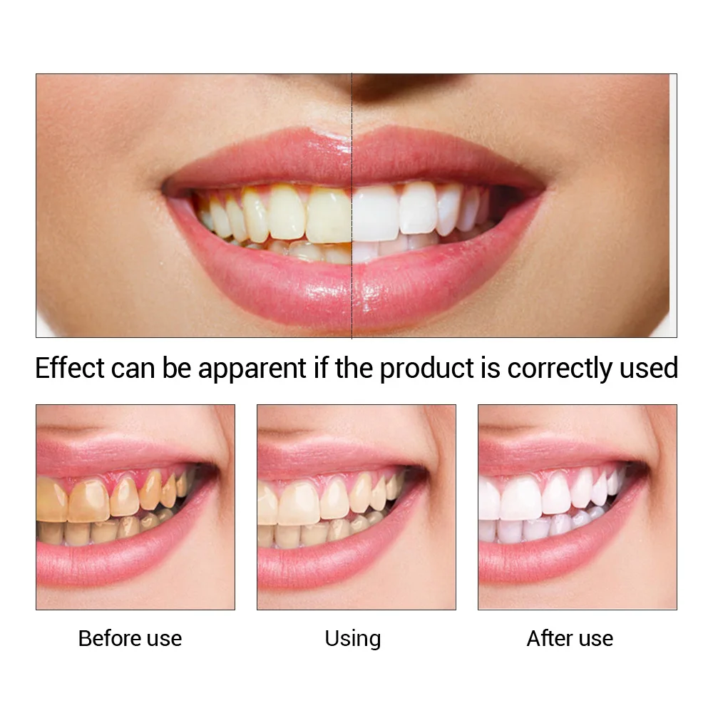 FTEENPLY Essência para claream - Teeth Whitening Near Me avaliação e preço