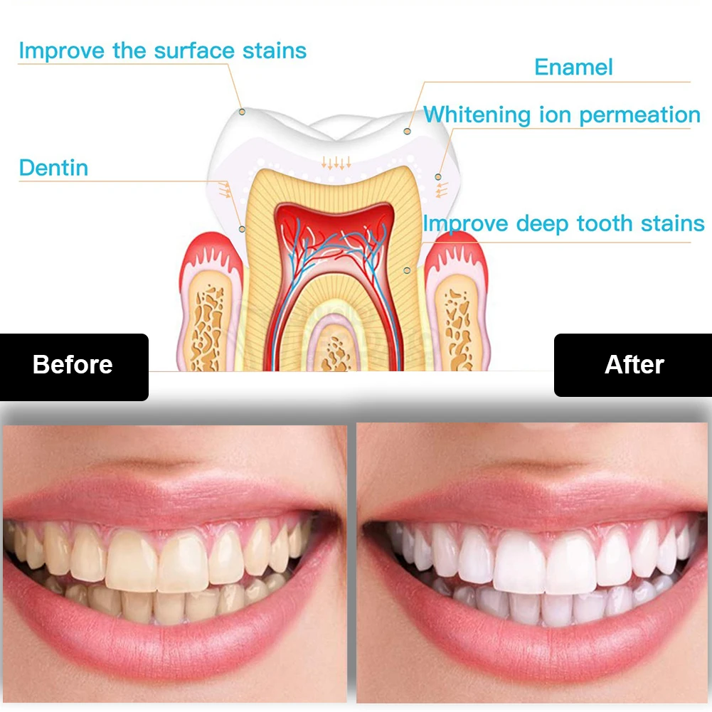 Kit de clareamento dental dos  - Teeth Whitening Device avaliação e preço