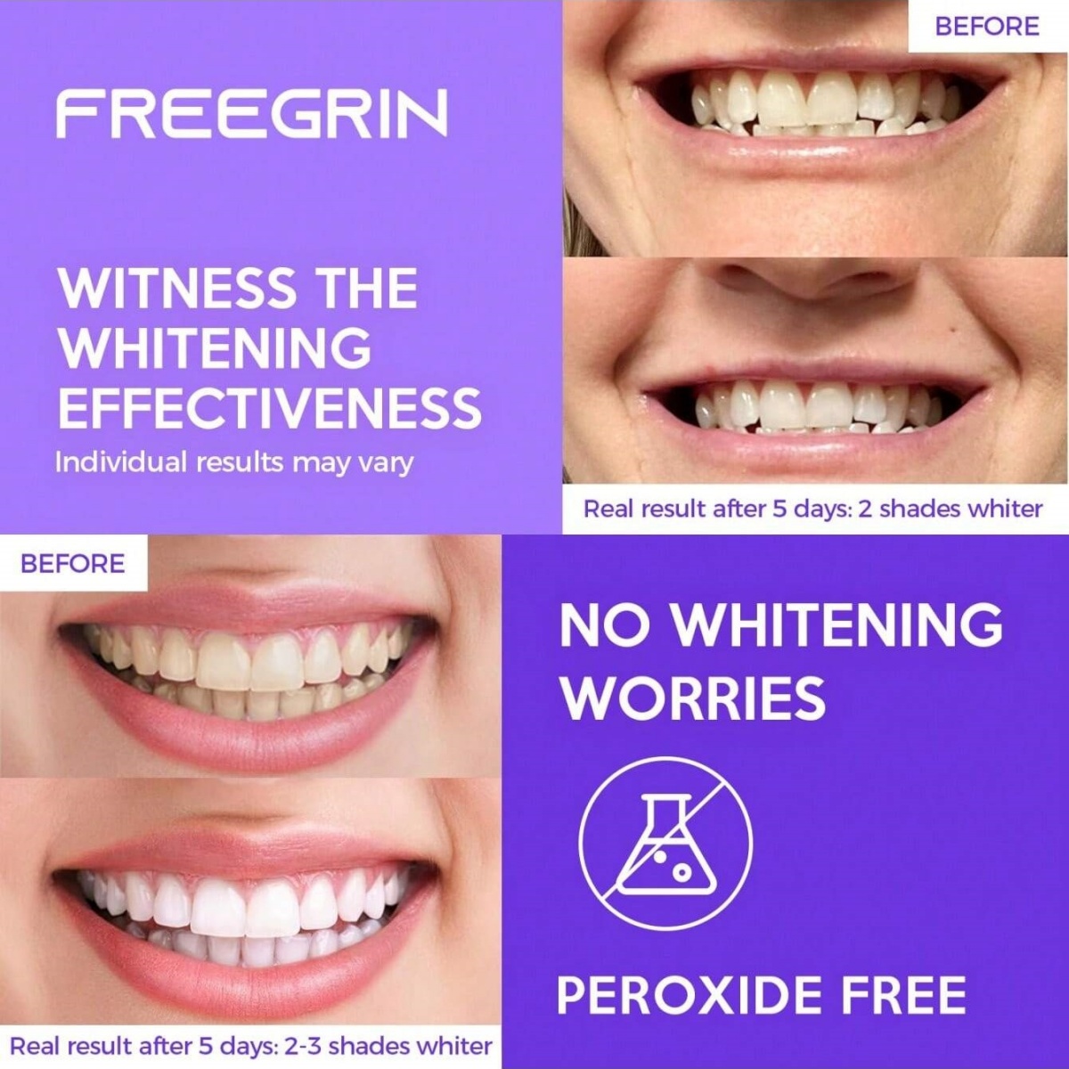Adesivos de clareamento dental - Teeth Whitening Near Me avaliação e preço
